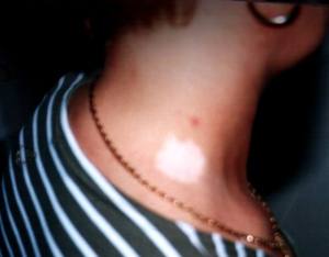 Vitiligo - pigmenthiányos bõrelváltozás (autoimmun betegség, gyakran társul Basedow-kórhoz vagy Hashimoto-betegséghez).